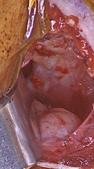 Operative photograph showing thick fascia obscuring the hypoglossal nerve; the ranine vein provides a landmark for locating the nerve superior to it.