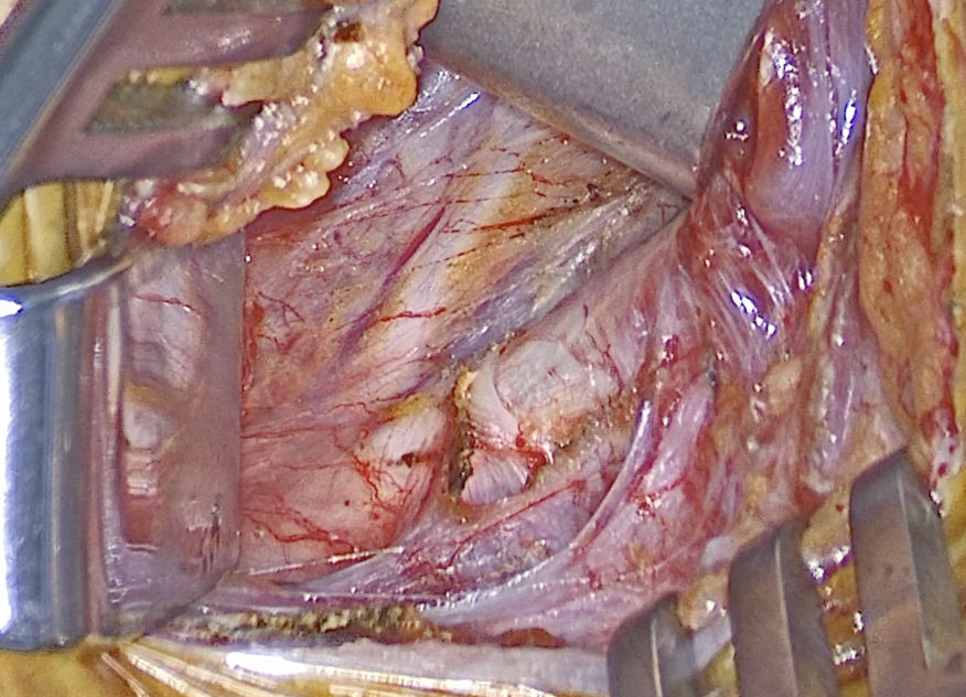 Operative photograph showing thin, transparent fascia with the hypoglossal nerve and its branches visible beneath it.