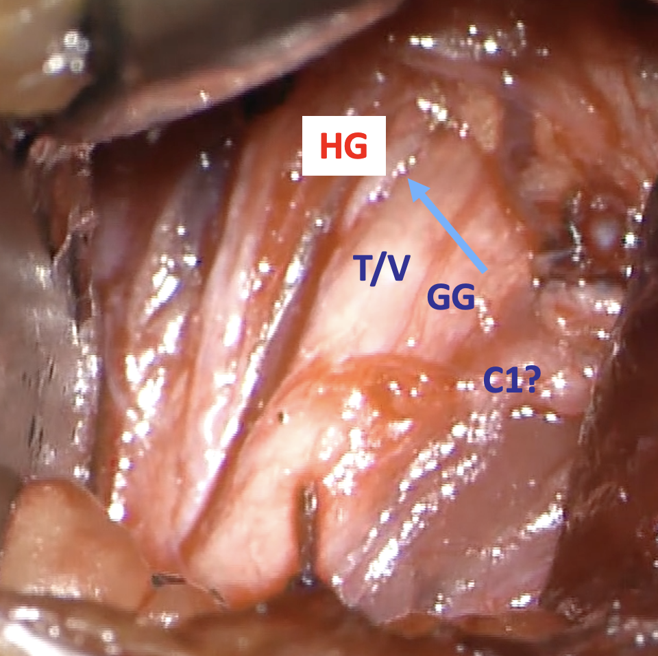 Operative photograph from slide 29. A blue arrow identifies the late hyoglossus retractor branch beside the T/V and genioglossus inclusion fibers; a possible C1 branch is labeled with a question mark.