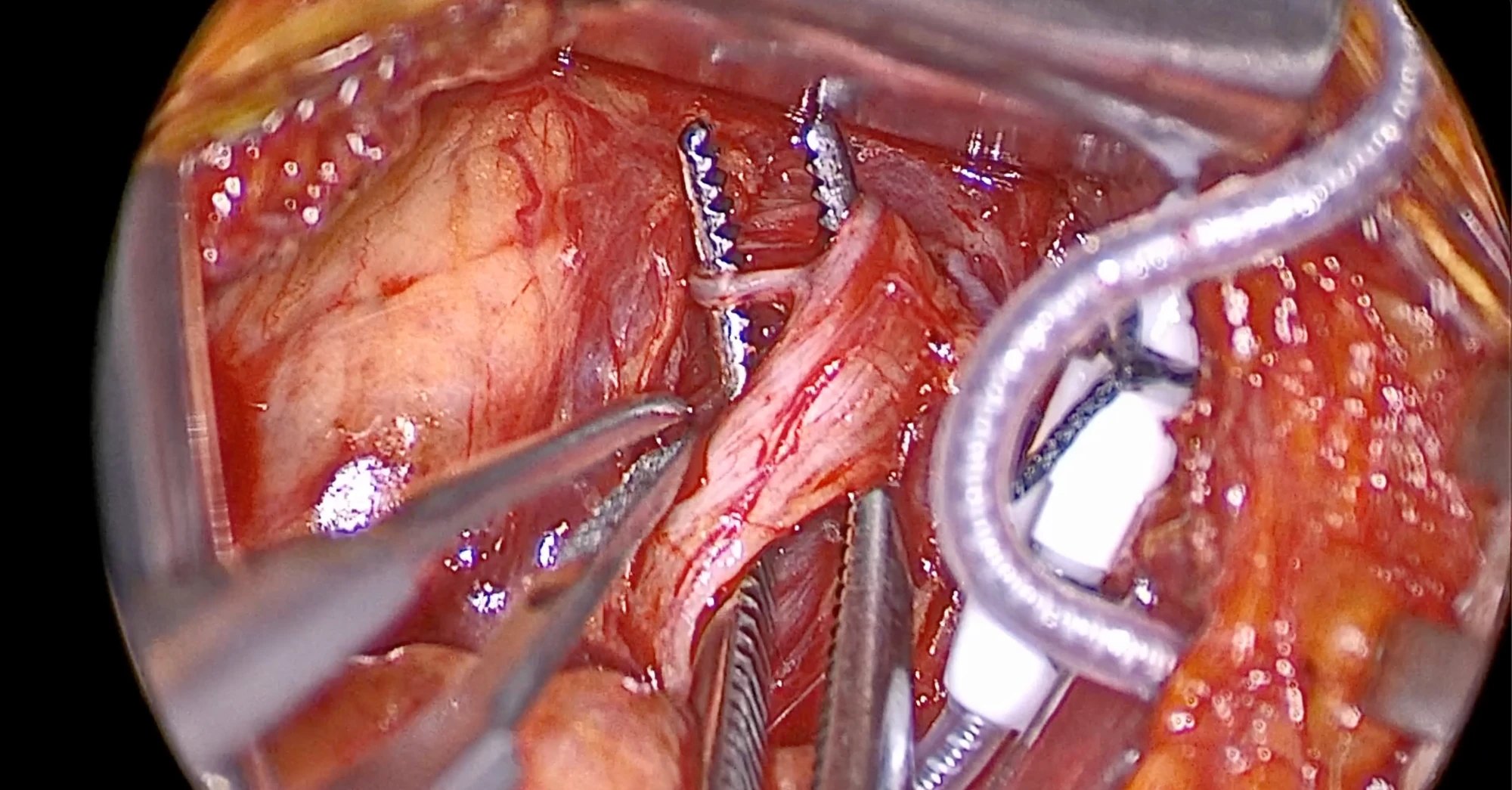 Circular magnified operative view of the hypoglossal nerve running diagonally from the bottom center toward the top. In the upper part of the field, a thin branch leaves the main bundle and hooks around the left of two vertical toothed metal tines at the top center; the right tine rests beside the main bundle. Fine-tipped forceps enter from the left and two ridged instruments rise from the bottom center. At the right, the white stimulation cuff, not yet on the nerve, sits within a large loop of its silver coiled lead.