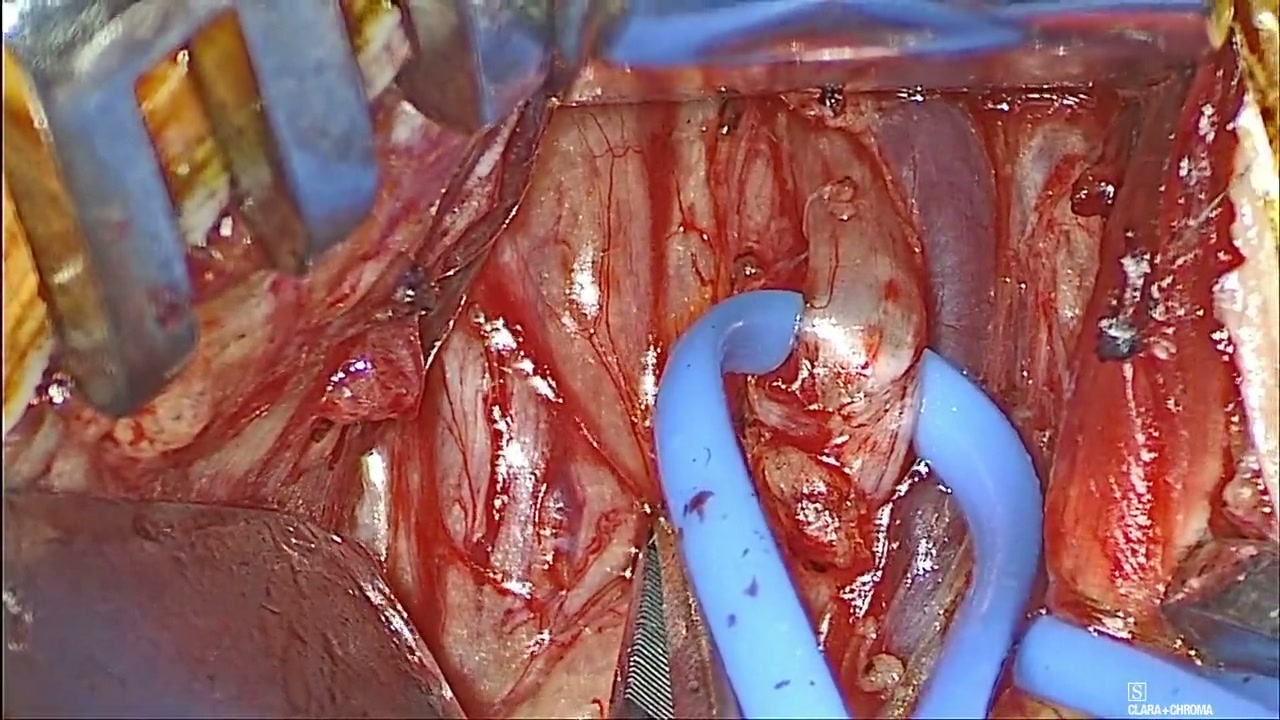 Recognize the lingual nerve in operative teaching footage
