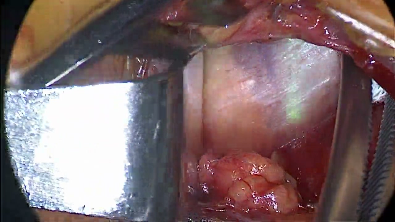 Find the free edge of the mylohyoid in operative teaching footage