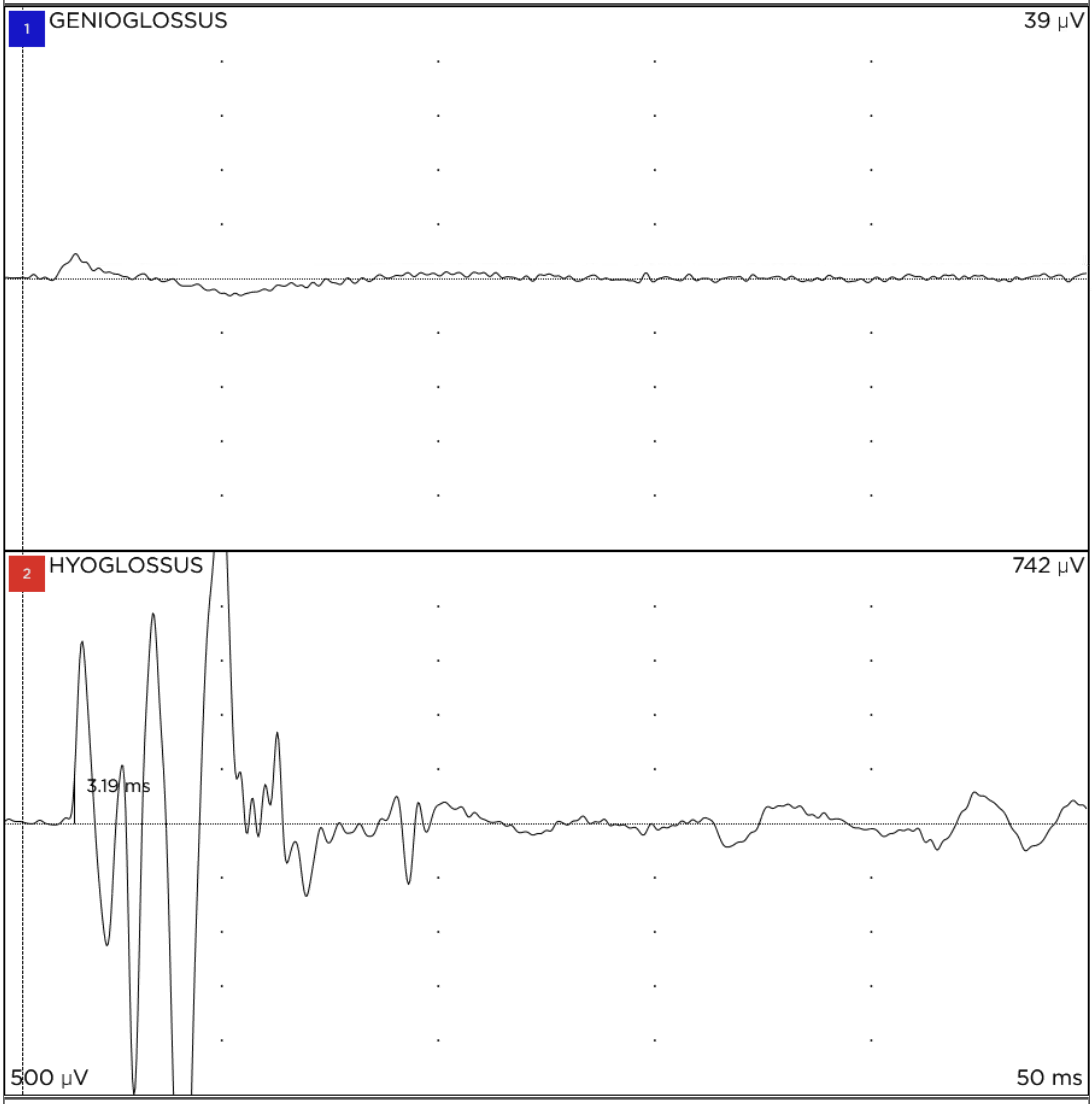 NIM readout with minimal upper, blue-labeled activity and a robust lower, red-labeled hyoglossus response followed by a prolonged low-amplitude tail.