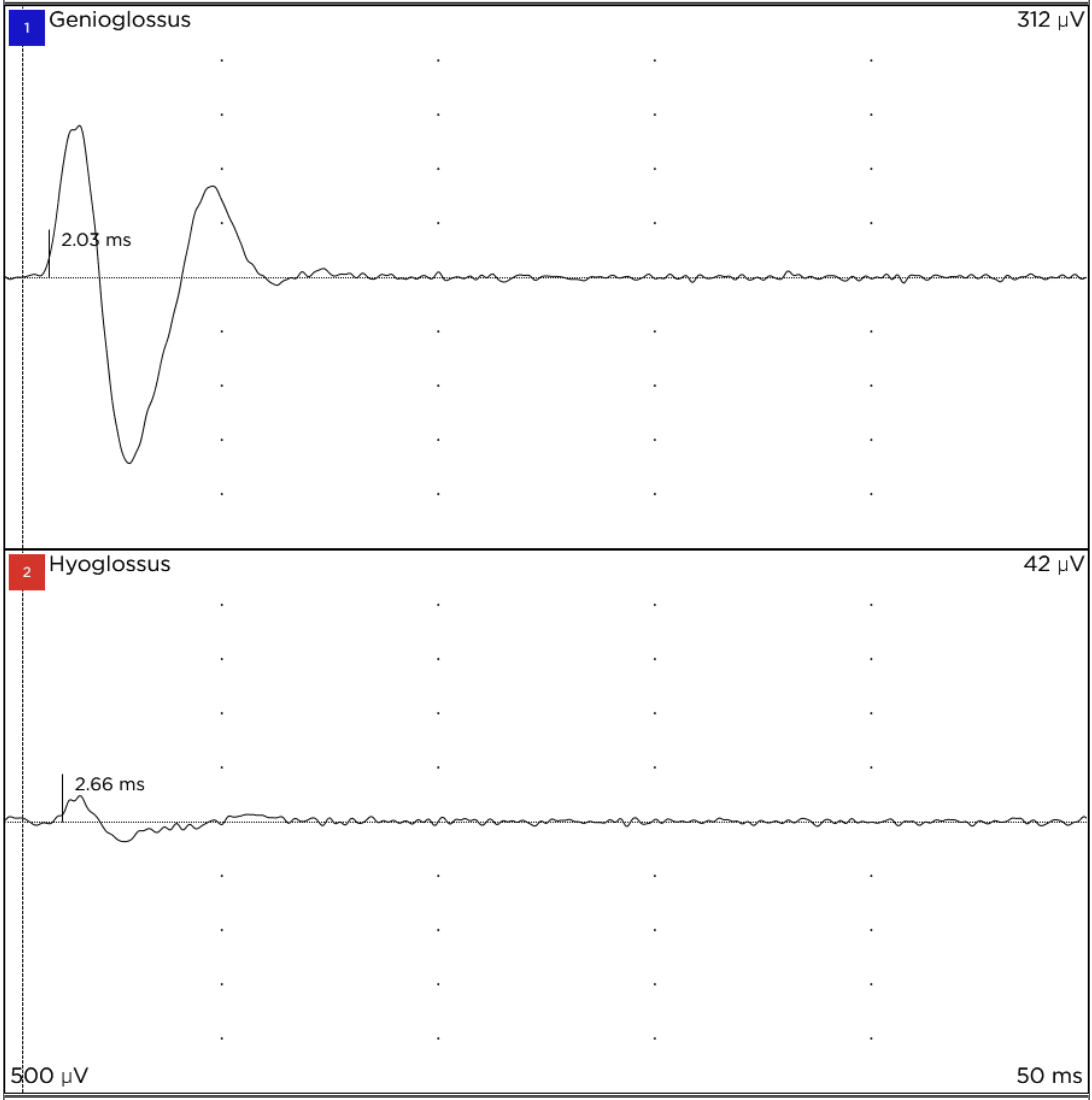 NIM readout with a clear upper, blue-labeled genioglossus response and minimal lower, red-labeled channel activity.