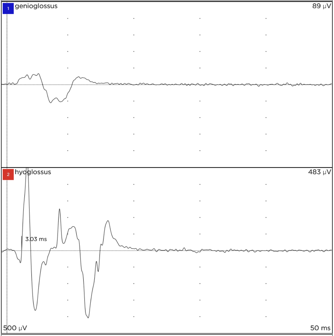 NIM readout with an upper, blue-labeled response and sharp lower, red-labeled peaks that continue after the upper response has settled.