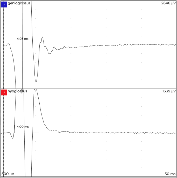 NIM readout showing strong responses in both channels over a similar interval; the lower, red-labeled channel returns to baseline without a distinct late tail.