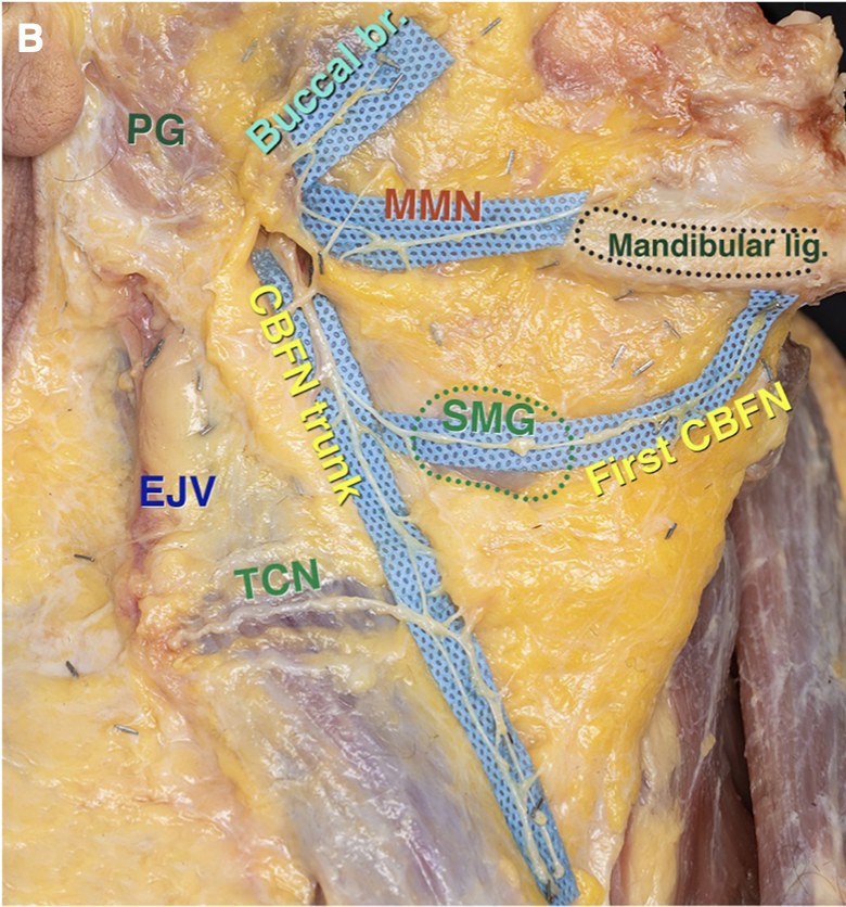 Cadaver dissection of the upper neck with the facial nerve branches laid over blue strips and labeled: the cervical trunk descending from the parotid gland, the first cervical branch crossing the submandibular gland toward the mandibular ligament, and the marginal mandibular nerve running along the mandible.