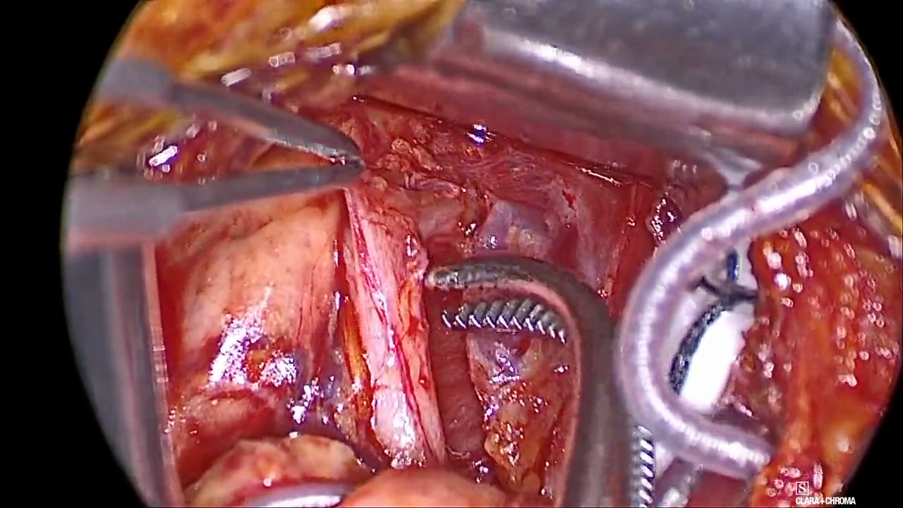Retraction prompts another look in operative teaching footage