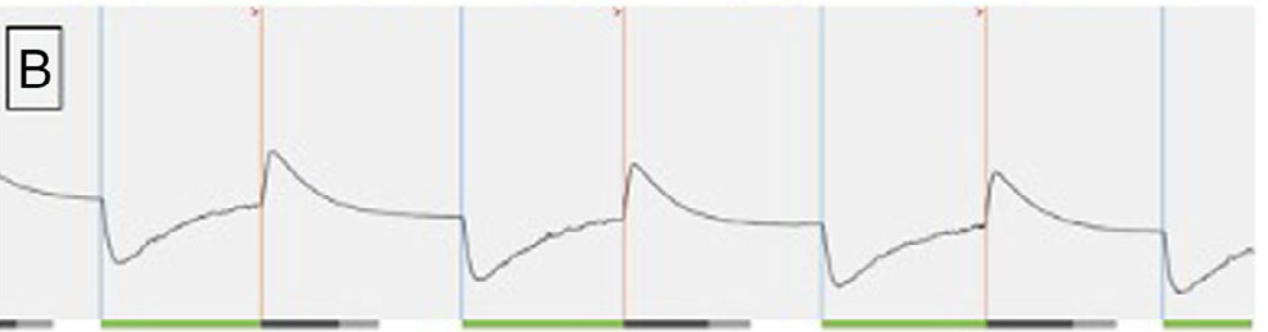 Respiratory sensing trace with repeated abrupt deflections and sloping returns, creating a shark-fin appearance. Original panel B from Islam and colleagues, Figure 3.