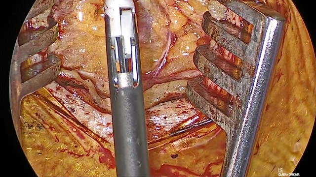 Early submandibular exposure in the CoolSeal operative teaching video