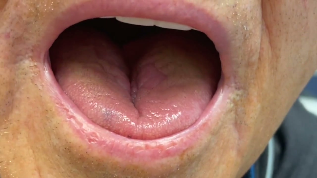 Unhindered tongue protrusion in operative teaching footage
