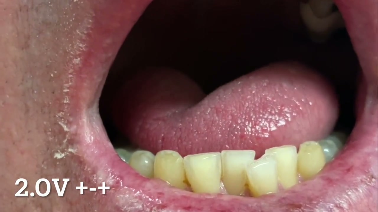 Recognize tongue retraction in operative teaching footage