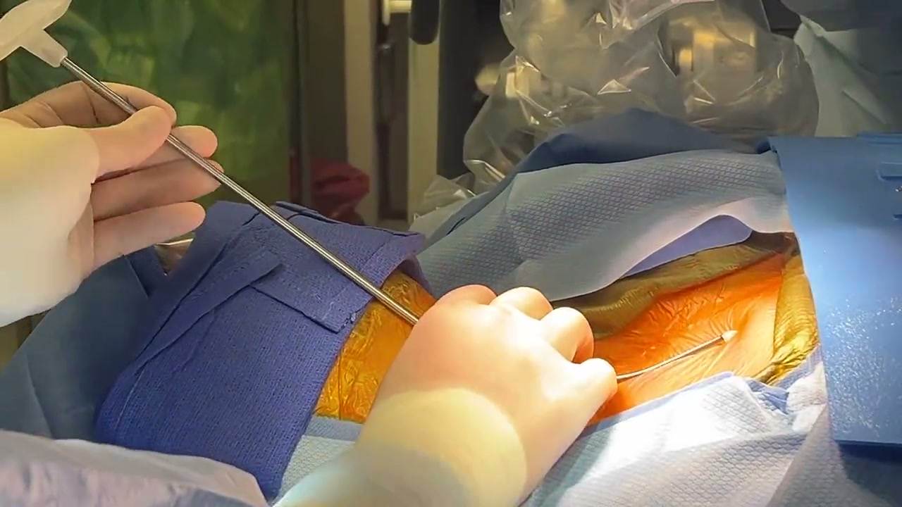 The tunneler following a superficial route in operative teaching footage
