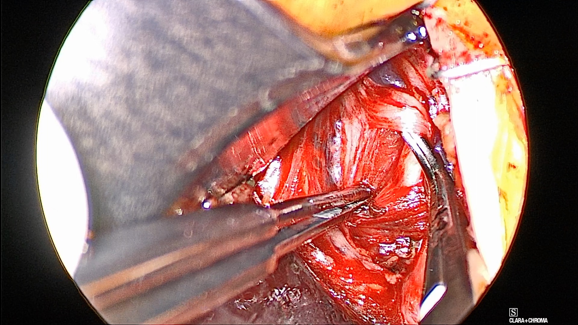 Operative Wishbone Sign: nerve bundles spread at the initial breakpoint come back together distal to the instrument tips.