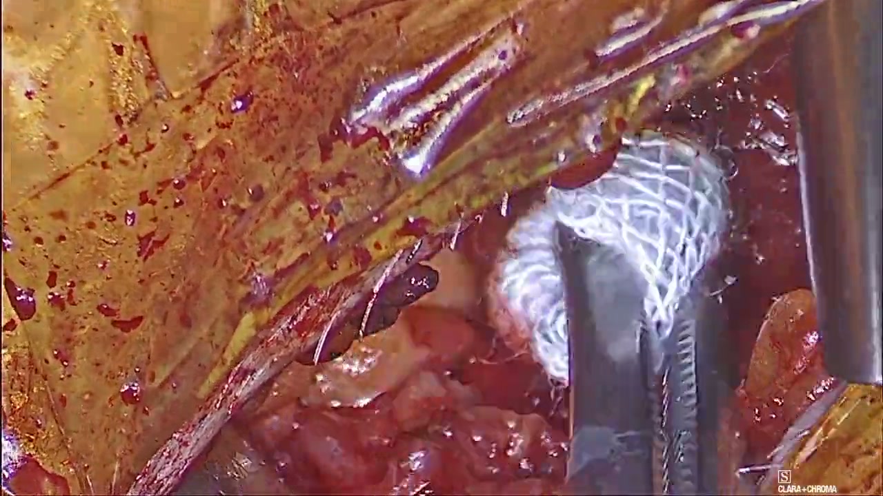 The nerve to mylohyoid trap in operative teaching footage